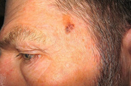Dezvoltarea melanomului - simptome și tratamentul cancerului de piele