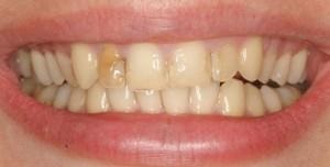 Restaurarea dinților cu furnire - recenzii, prețuri, fotografii înainte și după, contraindicații - viața mea