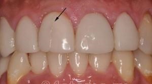 Restaurarea dinților cu furnire - recenzii, prețuri, fotografii înainte și după, contraindicații - viața mea