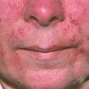 Rosacea pe față - tratament foto, derm-info