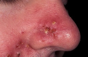 Rosacea pe față - tratament foto, derm-info