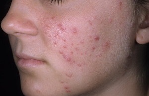 Rosacea pe față - tratament foto, derm-info