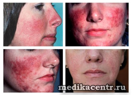 Rosacea - boala cutanată a feței