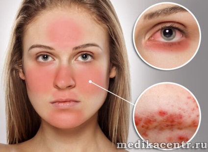 Rosacea - bőrbetegség