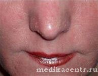 Rosacea - boala cutanată a feței