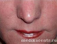 Rosacea - bőrbetegség