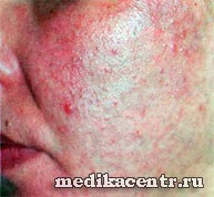 Rosacea - bőrbetegség