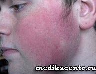 Rosacea - boala cutanată a feței