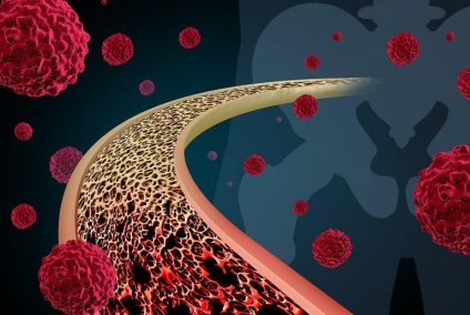 Sarcoma oaselor, cancer - tratament și prevenire