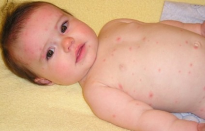 Simptomele fazei inițiale a varicelei la seniori și copii