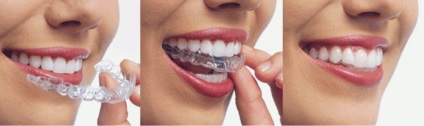 Invisalign rendszer ár, vélemények