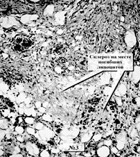 Nehézségek diagnosztizálására panniculitis Weber