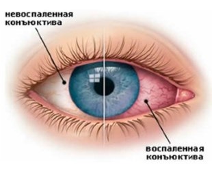 Lista bolilor oculare (boli oculare) diagnostic, tratament, prevenire