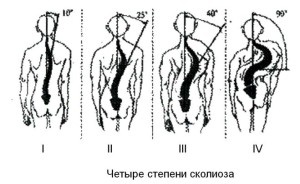 Grade de scolioză, tratament corect