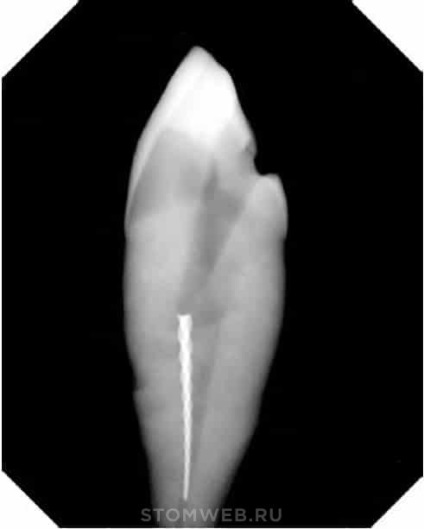 Stomweb - articol - crearea accesului la cavitatea pulpa a dinților din compartimentul frontal