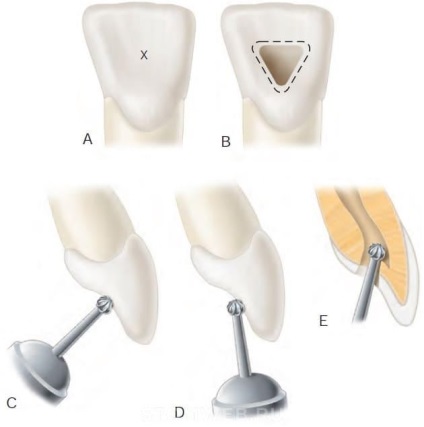 Stomweb - articol - crearea accesului la cavitatea pulpa a dinților în secțiunea frontală