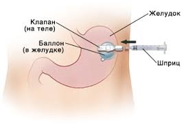 Eliminarea gastrostomiei cum se elimină gastrostomia la domiciliu, numiți un gastroenterolog acasă