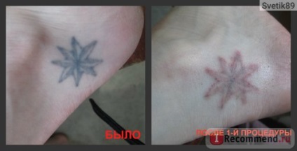 Îndepărtarea cu laser a tatuajelor - 