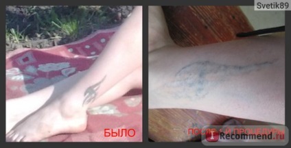 Îndepărtarea cu laser a tatuajelor - 