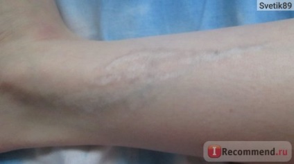 Îndepărtarea cu laser a tatuajelor - 