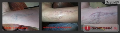 Îndepărtarea cu laser a tatuajelor - 