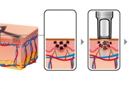 Îndepărtarea tatuajelor cu un laser este tot ce ați vrut să știți despre procedură