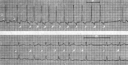 Gyorsított supraventricularis ritmus (klinikai kép) - supraventricularis tachycardia, rohamokban jelentkező