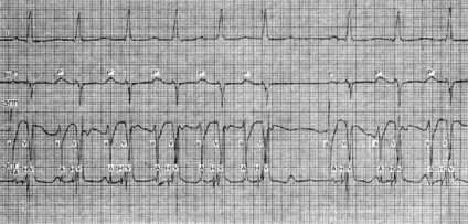 Ritm supraventricular accelerat (imagine clinică) - tahicardie paroxistică supraventriculară