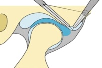 Dislocarea discului articular