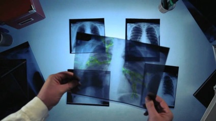 Ministerul Sănătății a propus tratarea bolnavilor cu tuberculoză la domiciliu
