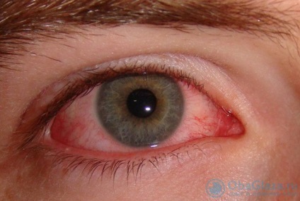 Inflamația corneei ochiului