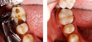 Restaurarea părții coroanei dintelui