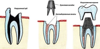 Restaurarea dinților - materiale, metode, costul restaurării smalțului dinților