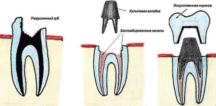 Helyreállítása a fogak - anyagok, eljárások, az árak helyreállását zománc