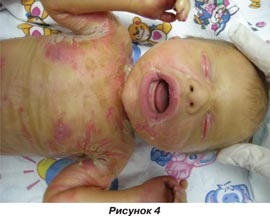 Erotrodermia ihtiosiformă congenitală a unei broșe neonatale, ediția online - știri medicale