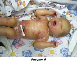 Erotrodermia ihtiosiformă congenitală a unei broșe neonatale, ediția online - știri medicale