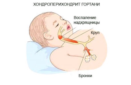 Cartilagiile laringelui - tiroidian, aritenoid, cricoid și altele