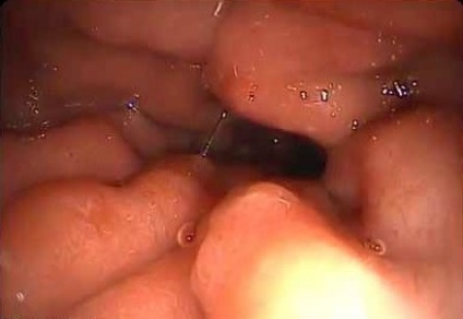 Gastroduodenita ulceroasă - cu un pas până la ulcer