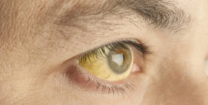 Proteine ​​de ochi galbeni în cauzele, simptomele, tratamentul persoanelor