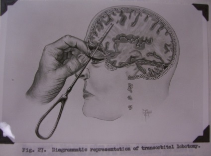 8 Fraza faptelor despre lobotomie - factum