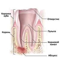 Din abcesul dinților