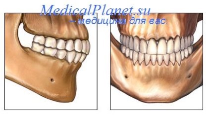 Uzură neutră anormală