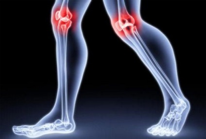 Arthritis a térd tünetek és népszerű kezelések
