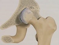 Artroza articulațiilor de șold - cum se tratează, medicina populară
