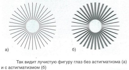 Astigmatismul provoacă copii, simptomele, tratamentul cu ochelari și lentile