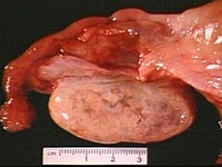 Ascite în cancerul ovarian - în stadiile 3, 4, prognostic, tratament