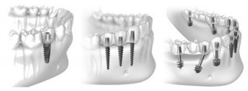 Implantarea bazală, implantarea directă, implantarea dinților, cum se fac dinții