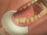Implantarea bazală, implantarea directă, implantarea dinților, cum se fac dinții