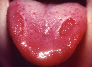 болест език - лечение на заболявания на езика