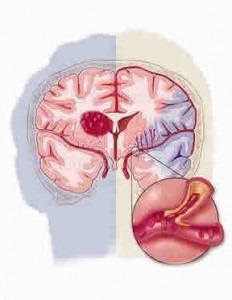 Cerebrovascular accident vascular cerebral, tulburări psihice organice